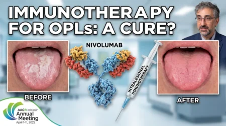 Clinical comparison of an oral leukoplakia lesion showing significant reduction after intralesional Nivolumab treatment.